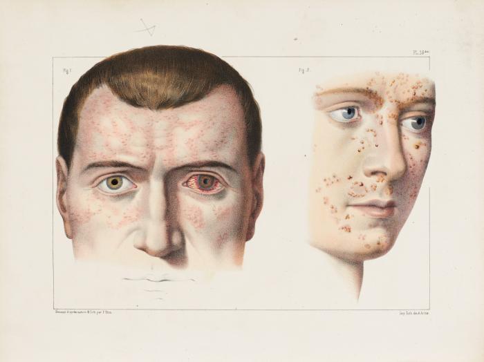 Traité complet des maladies vénériennes. Clinique iconographique de l'Hôpital des Vénériens, recueil d'observations, suivies de considérations pratiques ...
