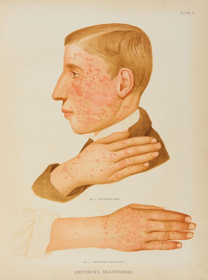 Atlas of the diseases of the skin. In a series of illustrations from original drawings with descriptive letterpress. 2 Bde.