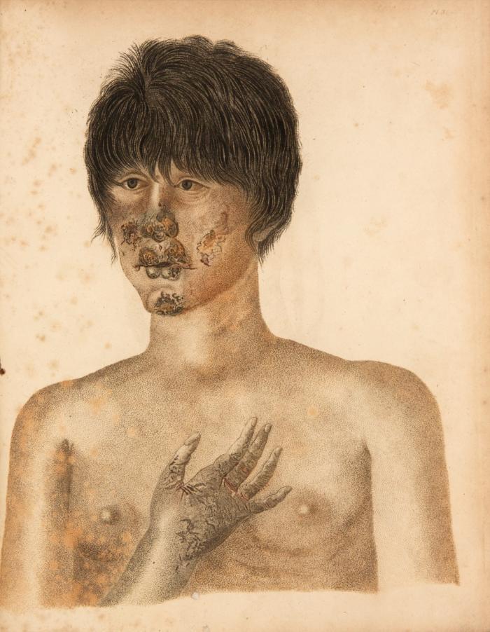 Observations on morbid poisons, chronic and acute. The first comprehending syphilis, yaws, sivvens, elephantiasis and the anomalia confounded with them. The second the acute contagions, particularly the variolous & vaccine. 2nd ed. ... and further commentaries on the doctrines of Mr. Hunter.
